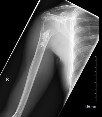 Natural history of intraosseous low-grade chondroid lesions of the proximal humerus